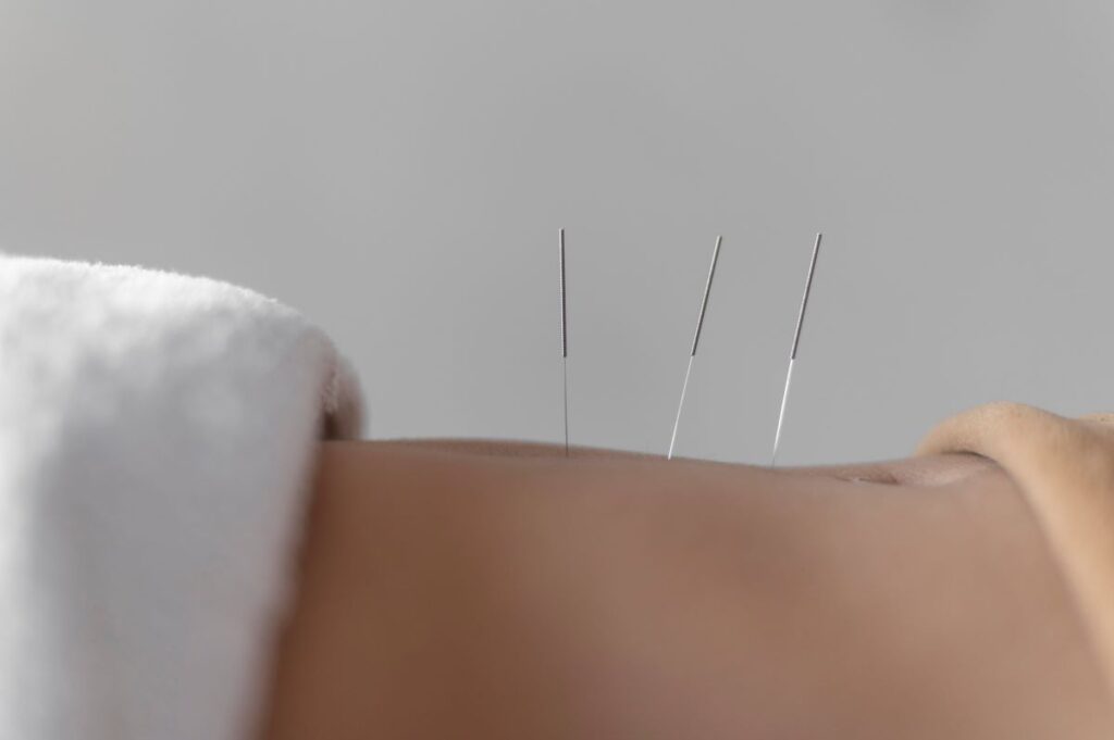 acupuncture for eating disorders needles in abdomen